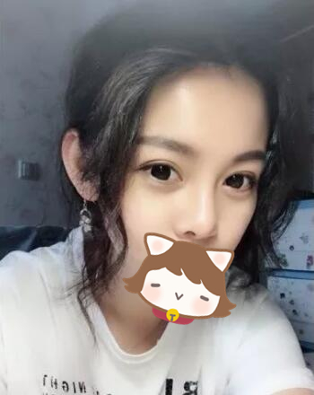 玻尿酸隆鼻前后果圖