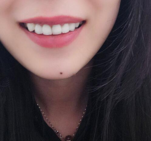 廣州牙齒整形日記分享