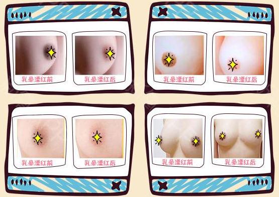 乳暈漂紅手術(shù)注意事項