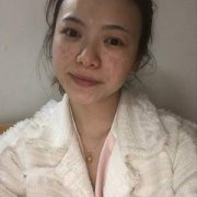 激光可以去除黃褐斑嗎？祛斑果圖分享，凈亮肌膚get！