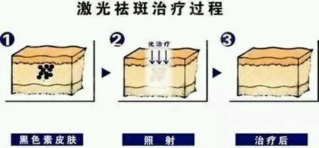 調(diào)Q激光的醫(yī)治黃褐斑實(shí)際果