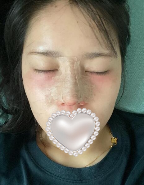 蘇州解放軍100醫(yī)院整形科隆鼻案例分享