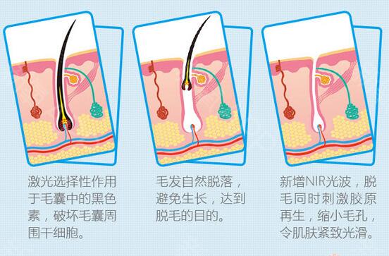激光脫毛多久一次