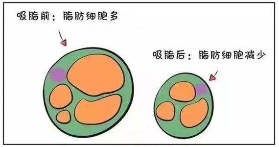 醫(yī)美減肥方法科普