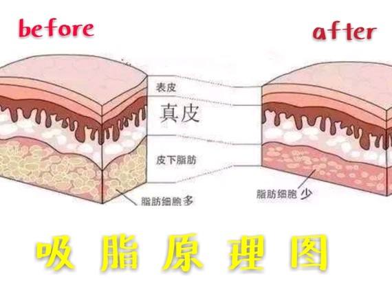 醫(yī)美減肥方法科普