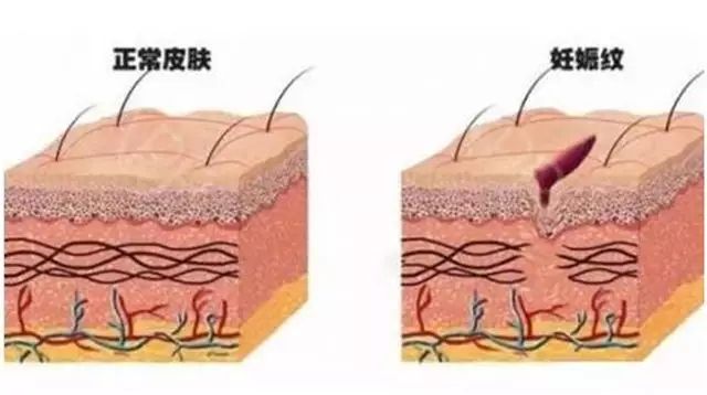 妊娠紋是怎么形成的