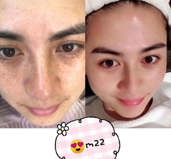 激光治雀斑后的常見問題有什么?