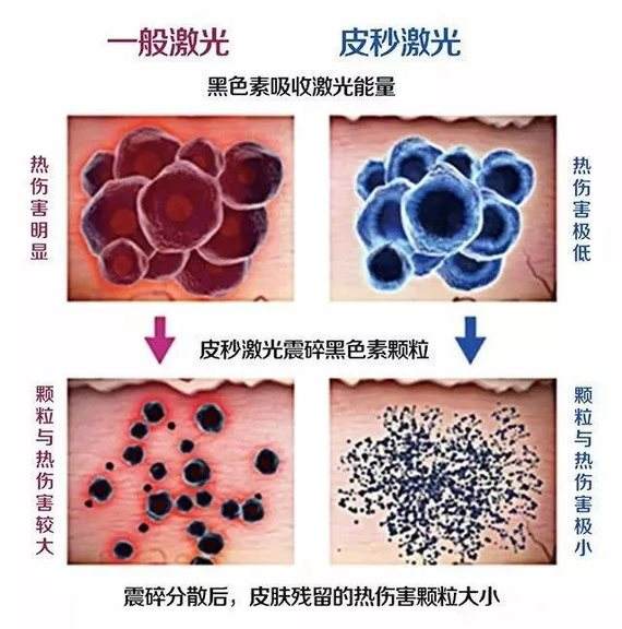 激光治雀斑的優(yōu)點有什么?