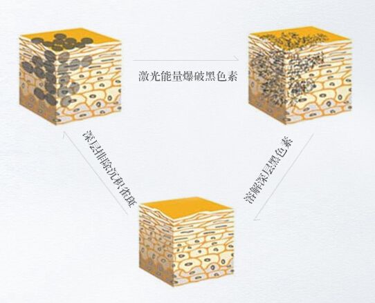 激光祛雀斑多少錢