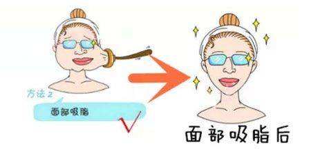 幾類普遍的整瓜子臉方式