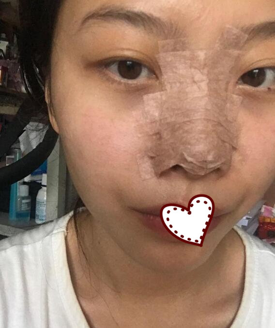 溫州雅美姬整形隆鼻案例分享