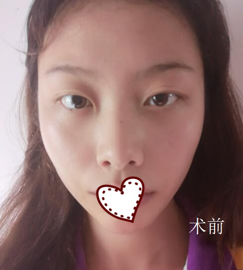 溫州雅美姬整形隆鼻案例分享