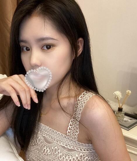 上海華美整形美容醫(yī)院隆鼻案例