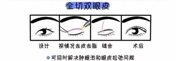 割一只雙眼皮多少錢(qián)