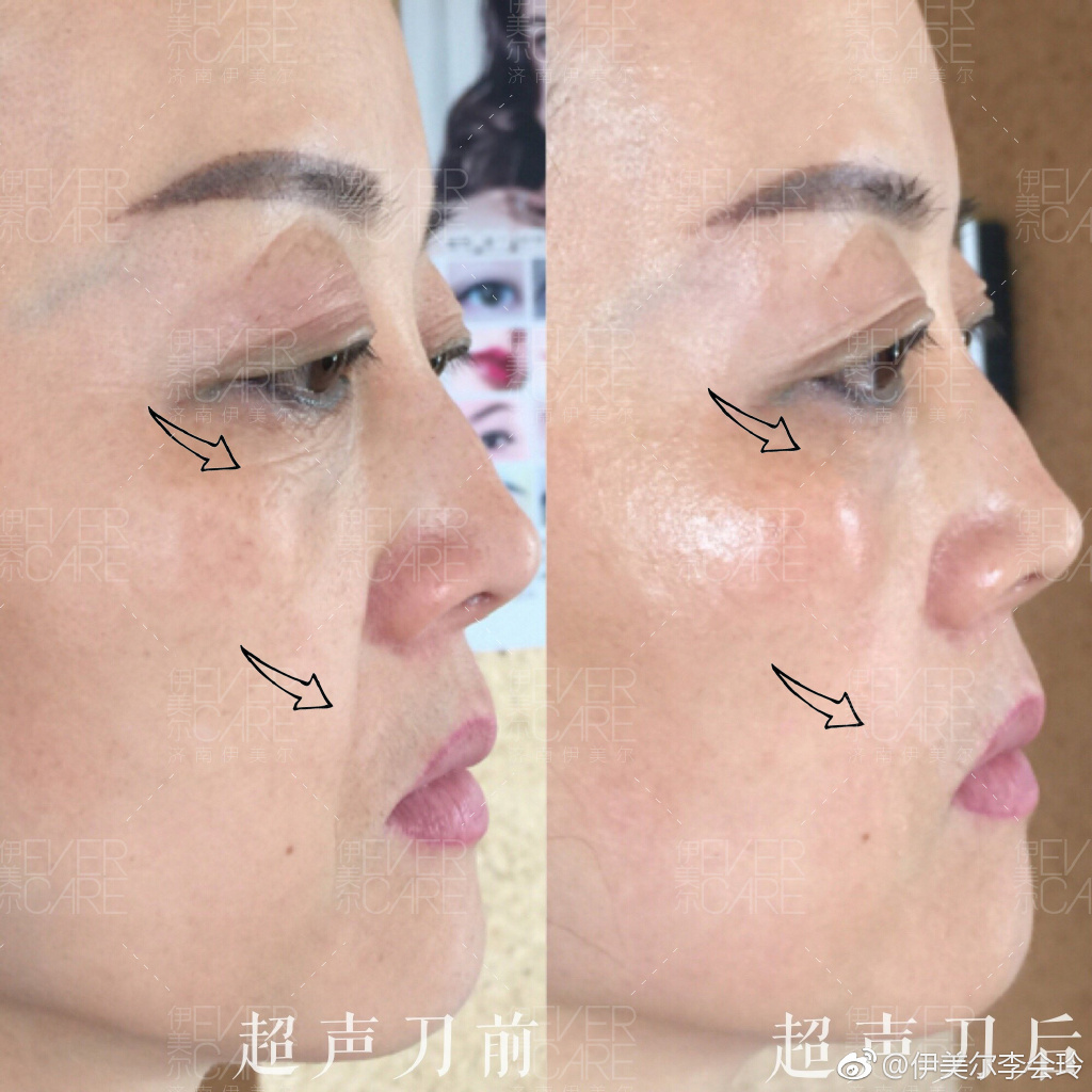 超聲提拉美容去除皺紋實(shí)際果怎么樣?