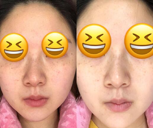 秦皇島巧致整形張凱華醫(yī)生激光美膚祛斑案例分享