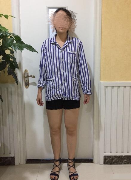 武漢愛思特胡可斌醫(yī)生吸脂瘦腿案例分享