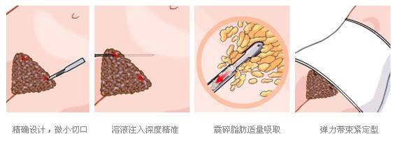 武漢美之仁整形美容醫(yī)院科普腰腹吸脂