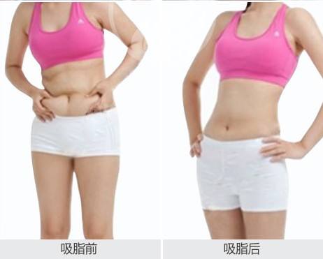 武漢美之仁整形美容醫(yī)院科普腰腹吸脂