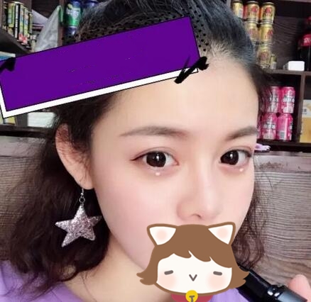 玻尿酸注射隆鼻果圖對比