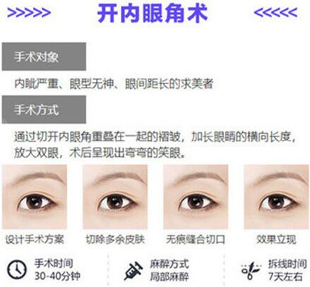 八大處宋濤醫(yī)生科普雙眼皮開眼角