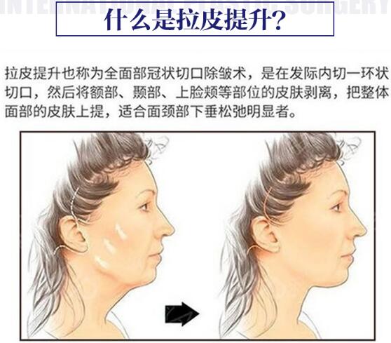 面部拉皮去皺整形