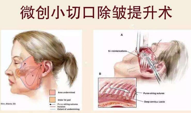 面部拉皮去皺整形