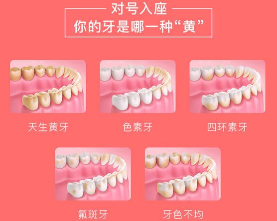 冷光美白牙齒的特點