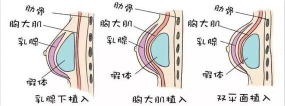 上海玫瑰醫(yī)療美容科譜隆胸整形手術(shù)
