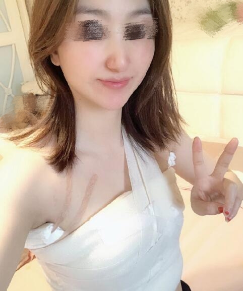 上海玫瑰醫(yī)療美容李鴻君隆胸案例分享
