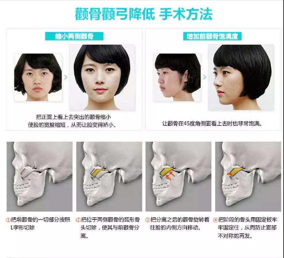 上海九院余東醫(yī)生科普顴骨整形的兩種方法