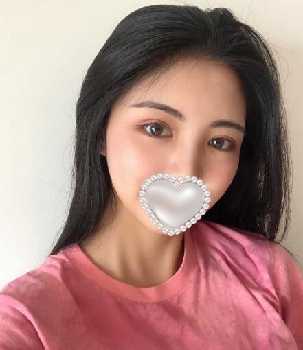 北京伊美爾做眼睛好嗎 案例分享