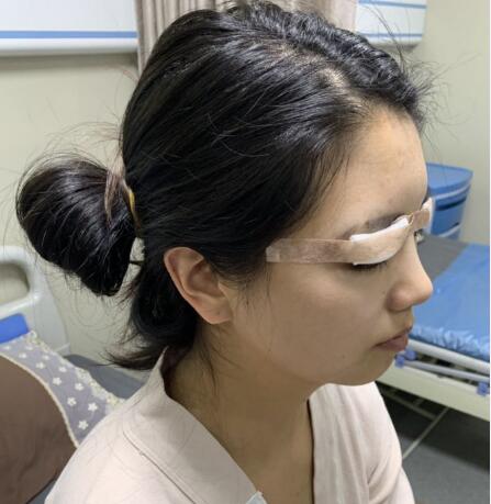 北京伊美爾做眼睛好嗎 案例分享