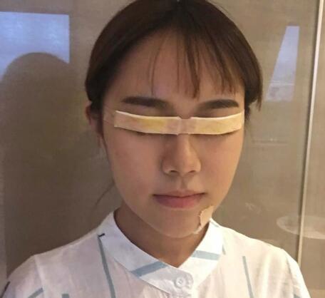 中山大學(xué)附屬第二醫(yī)院整形修復(fù)外科雙眼皮案例