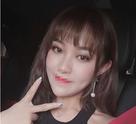 中山大學(xué)附屬第二醫(yī)院整形修復(fù)外科雙眼皮案例