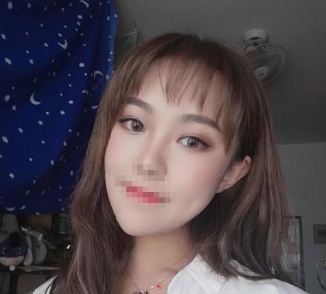 中山大學(xué)附屬第二醫(yī)院整形修復(fù)外科雙眼皮案例