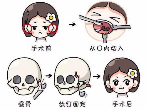 上海九院整形科顴骨內(nèi)推手術(shù)科普