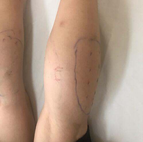 注射瘦臉注射瘦腿術后果圖分享