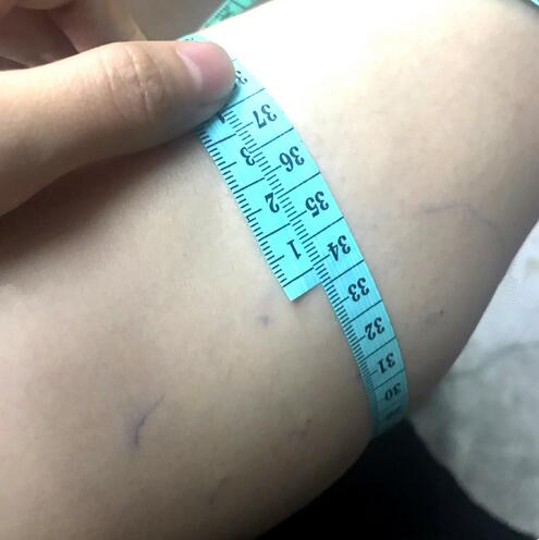 注射瘦臉注射瘦腿術后果圖分享
