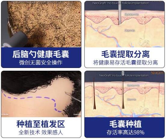 張鵬程醫(yī)生科普植發(fā)手術(shù)