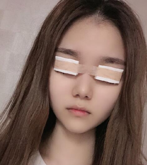 廈門美麗薇李國明醫(yī)生雙眼皮案例分享