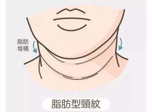 如何去除頸紋