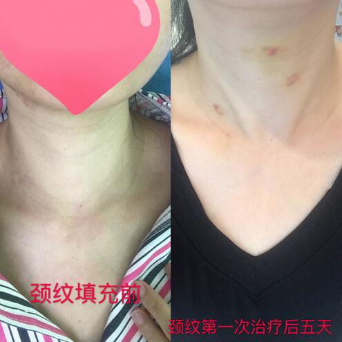 嗨體去頸紋