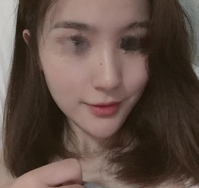 西安悅?cè)A整形醫(yī)院注射隆鼻案例分享