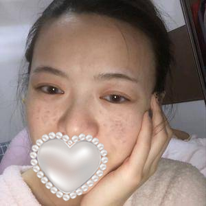 果酸換膚