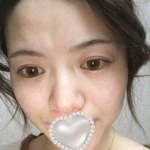 果酸換膚