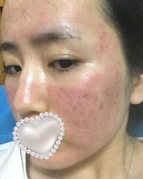 上海光博士齊顯龍醫(yī)生祛痘案例分享