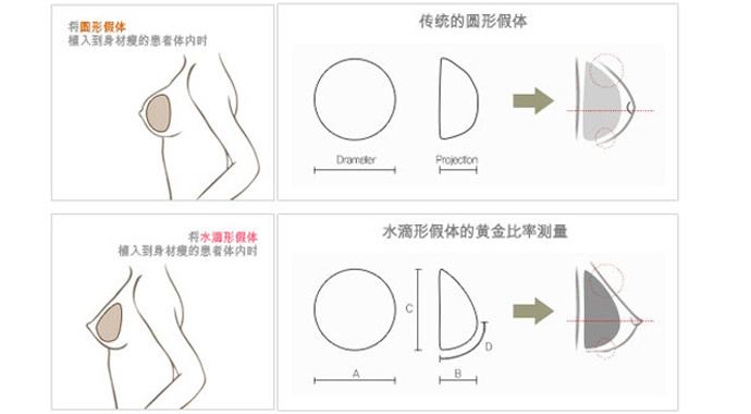 打豐胸針和假體哪個好