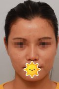 水滴鼻圖片曝光！來看本人做水滴鼻的真實果吧！附價格表