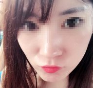 嘟嘟唇圖片曝光！真人做豐唇手術(shù)恢復(fù)期間實拍圖！